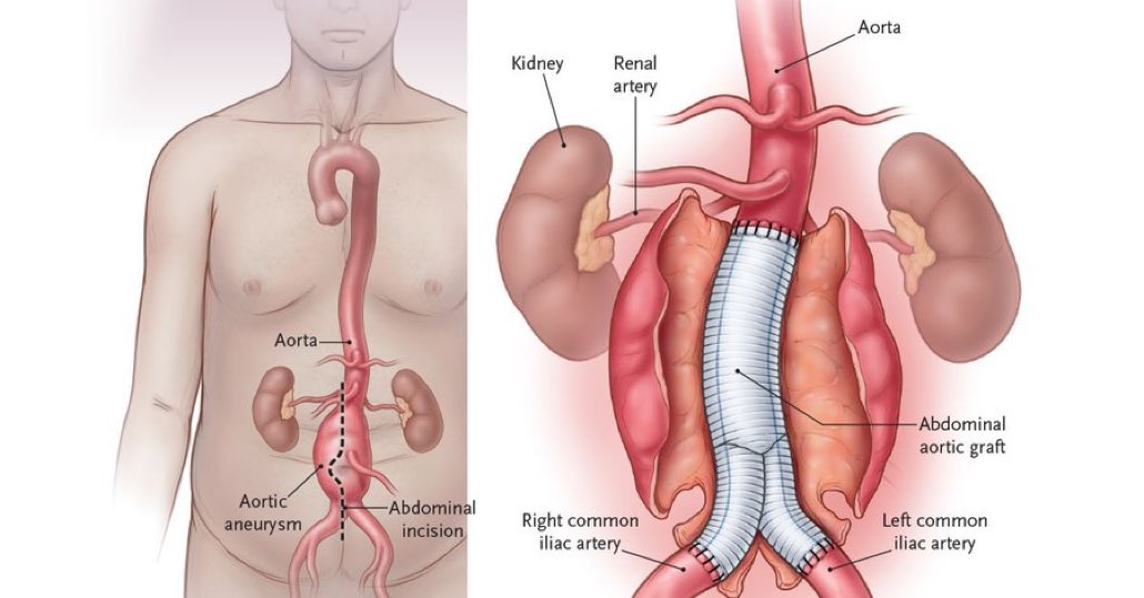 Abdominal Aort Anevrizması: Nedenleri, Belirtileri ve Tedavi Yöntemleri